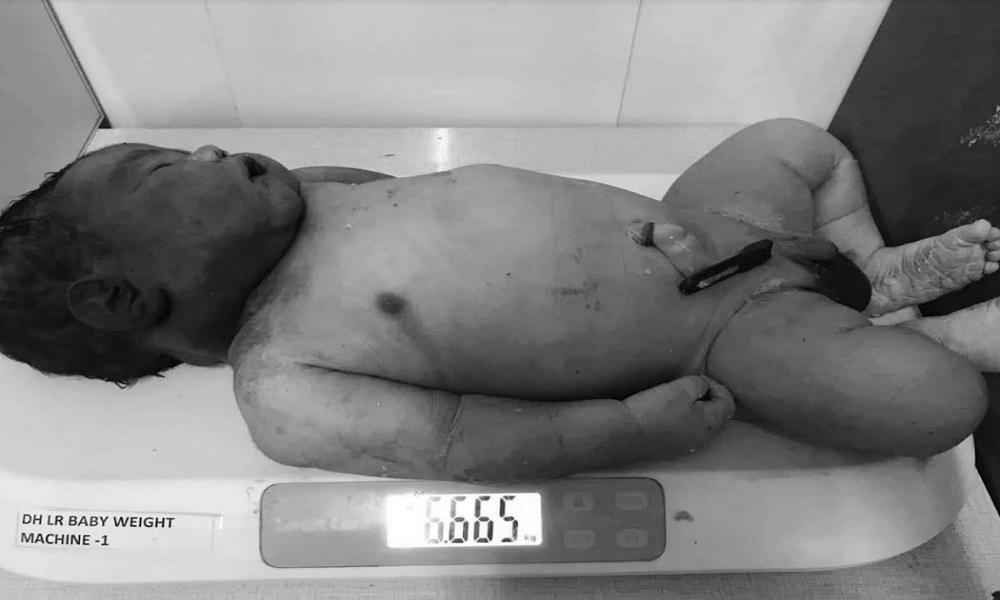 धुलिखेलमा ७ किलोको बच्चा जन्मने क्रममा काँध अड्किएर मृत्यु